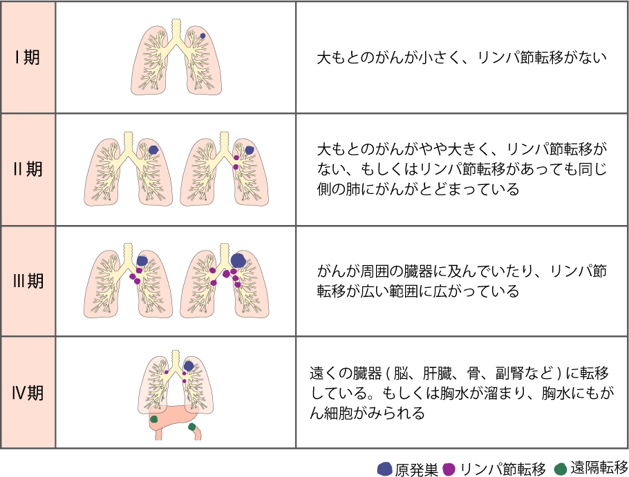 肺がんのステージ