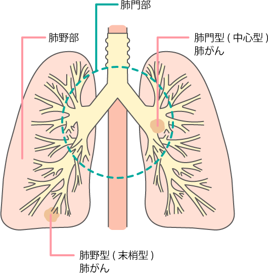 肺がんの発生部位