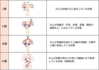 卵巣がんの病期
