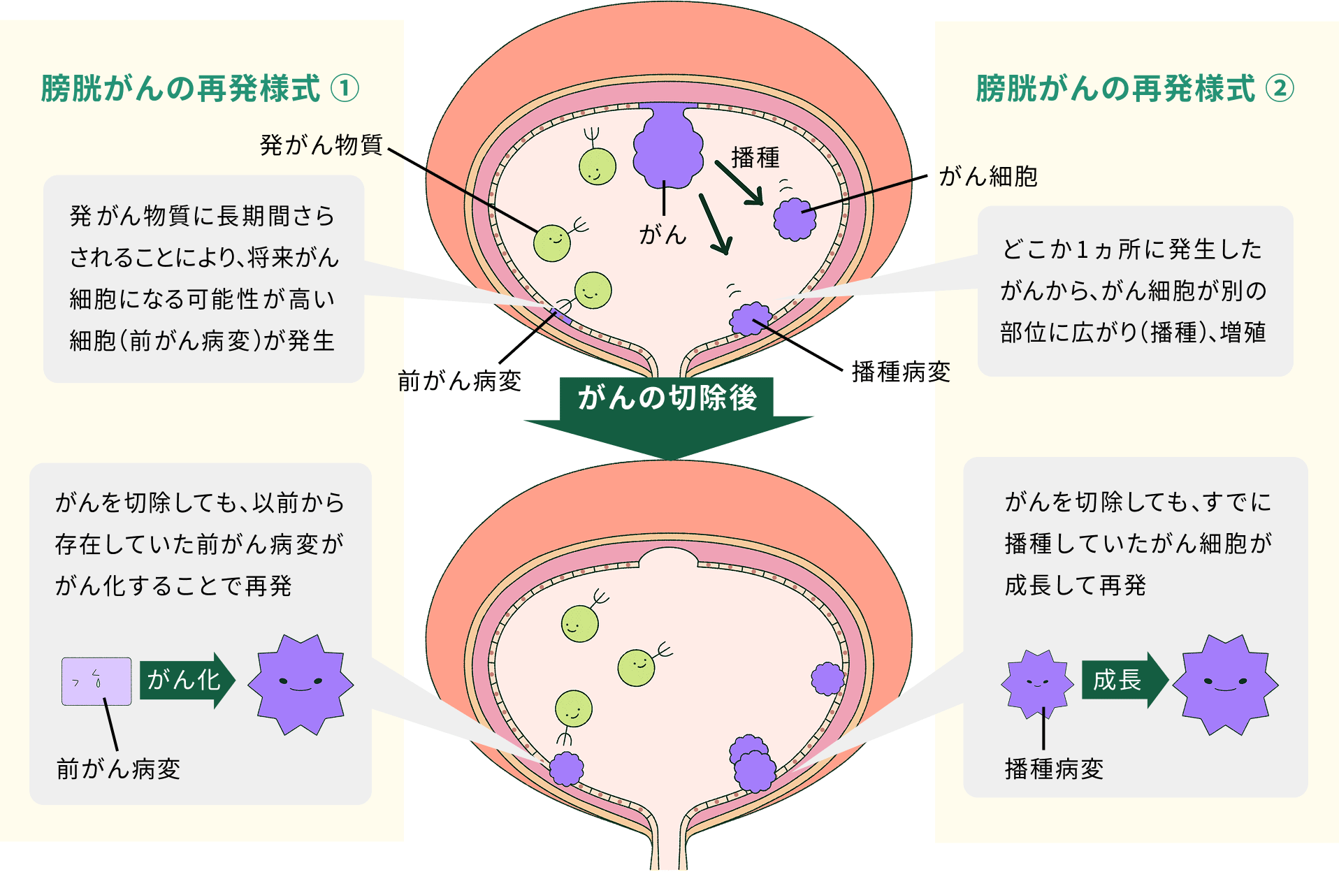 膀胱がんの再発様式