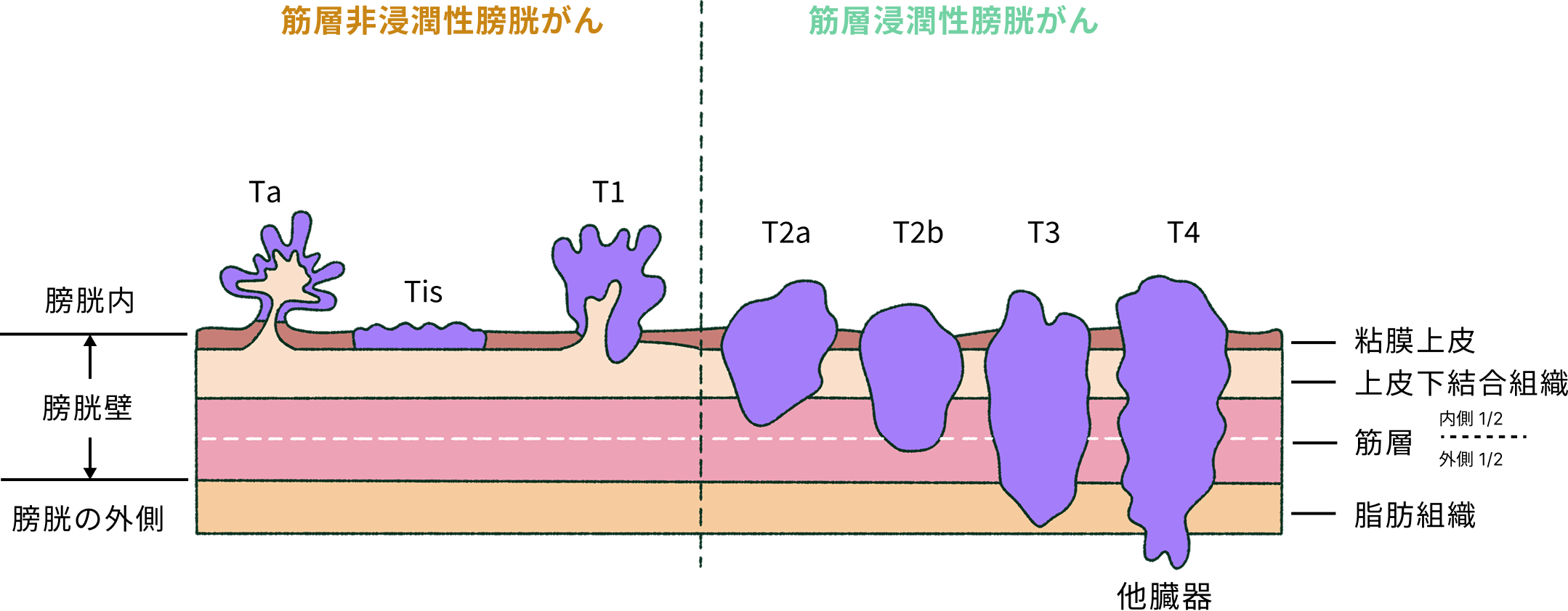 膀胱がんの深達度と分類