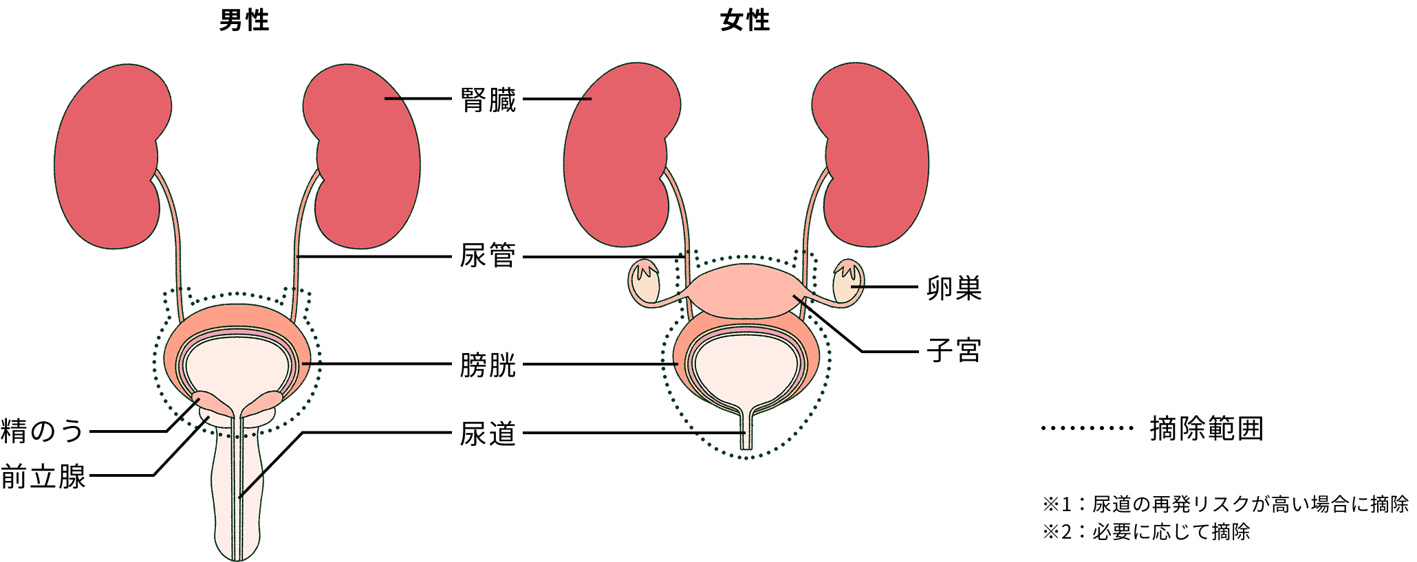膀胱全摘除術の摘除範囲