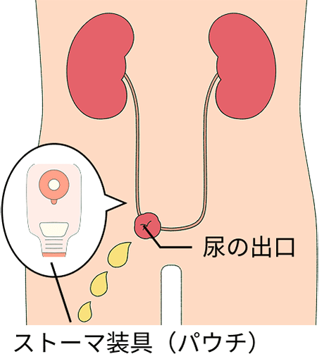 尿管を直接、腹壁に固定し、体外にパウチを貼付する