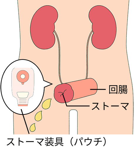 回腸（小腸の一部）を導管として用い、腹壁に固定し、体外にパウチを貼付する