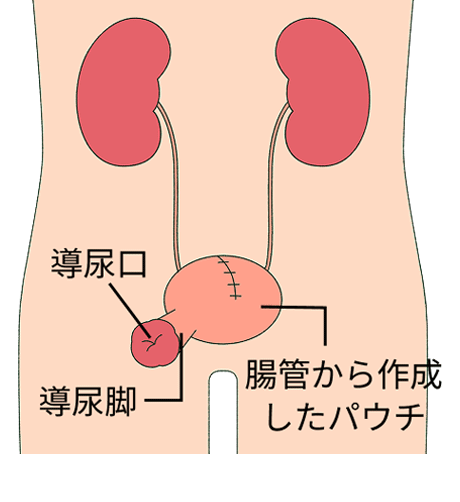 腸管（主に回腸）を用いて蓄尿するパウチを作成し、導尿脚を腹壁に固定する