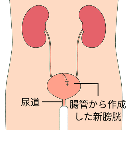 腸管（主に回腸）を用いて新たに膀胱を作成し、自己の尿道につなぎ合わせる