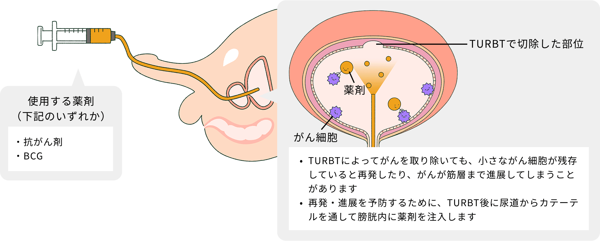膀胱内注入療法