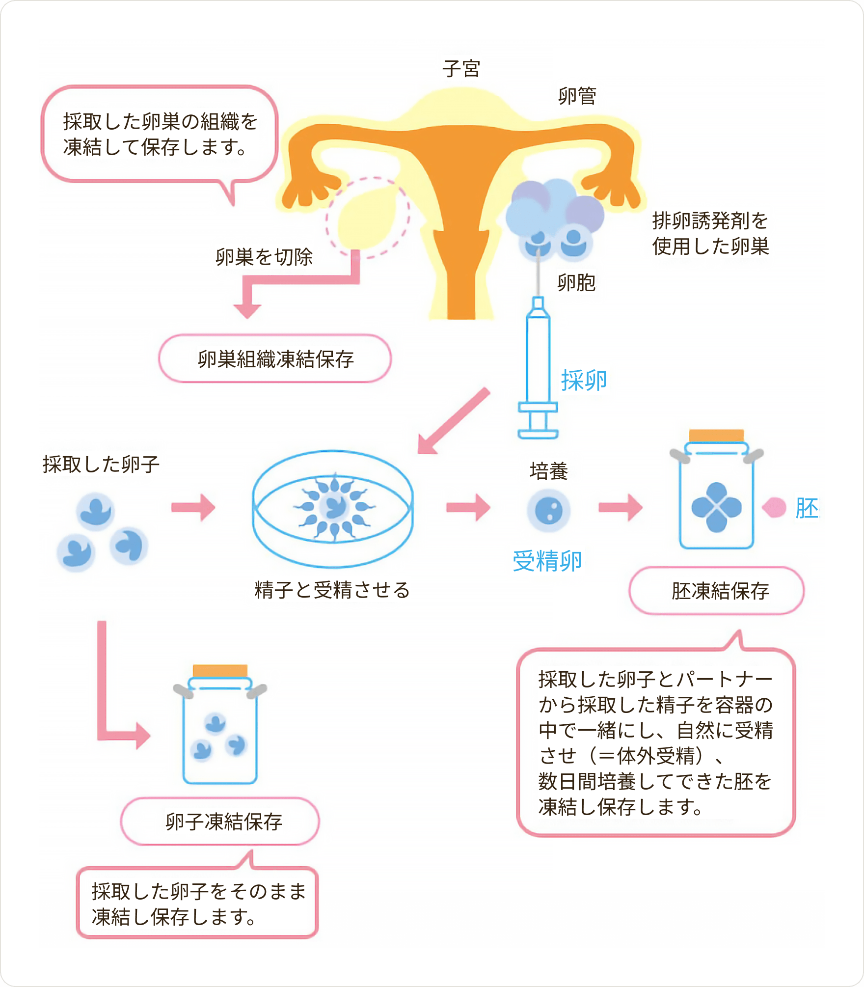 画像女性の場合の対策：凍結保存