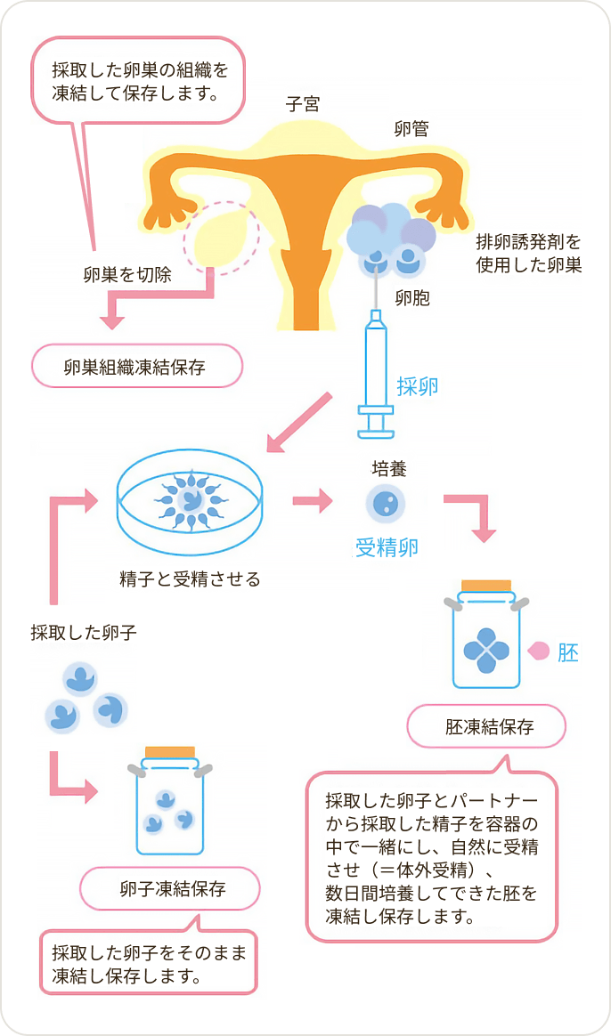 画像 女性の場合の対策：凍結保存