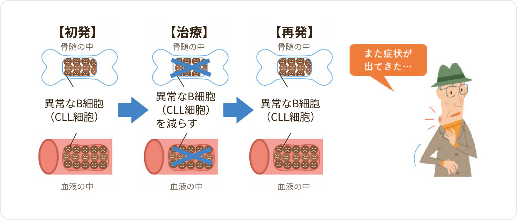 画像 慢性リンパ性白血病（CLL）の再発