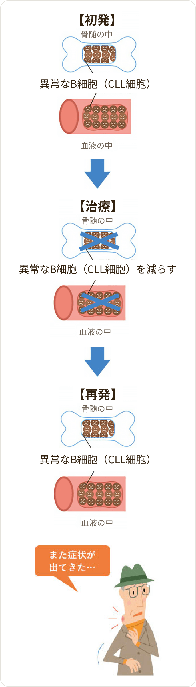 画像 慢性リンパ性白血病（CLL）の再発