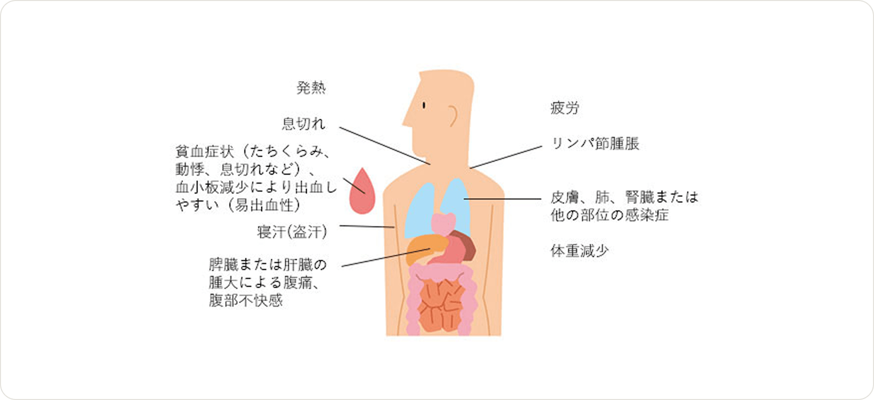 画像 CLL細胞が体内で増えてくると、症状が出てくる