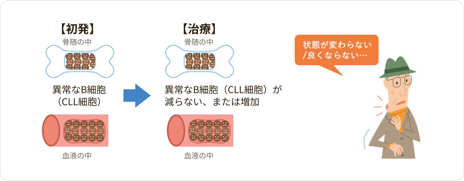 画像 難治性（治療抵抗性）の慢性リンパ性白血病（CLL）