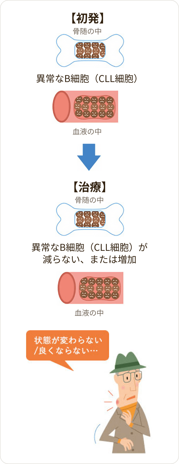 画像 難治性（治療抵抗性）の慢性リンパ性白血病（CLL）
