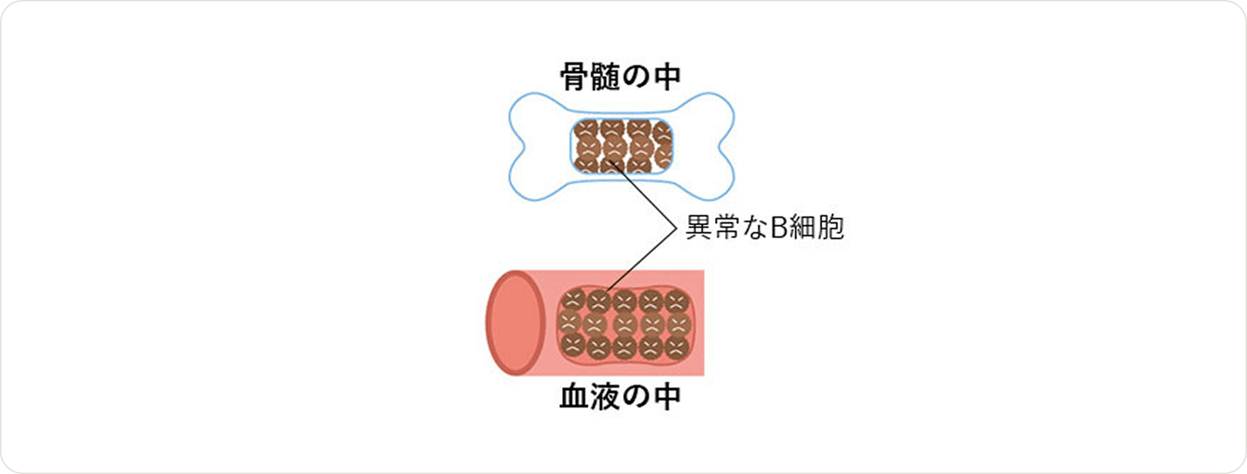 画像 異常なB細胞