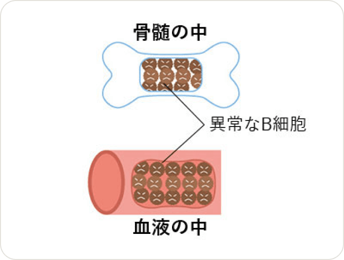 画像 異常なB細胞