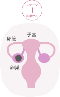 ステージⅠ卵巣がん