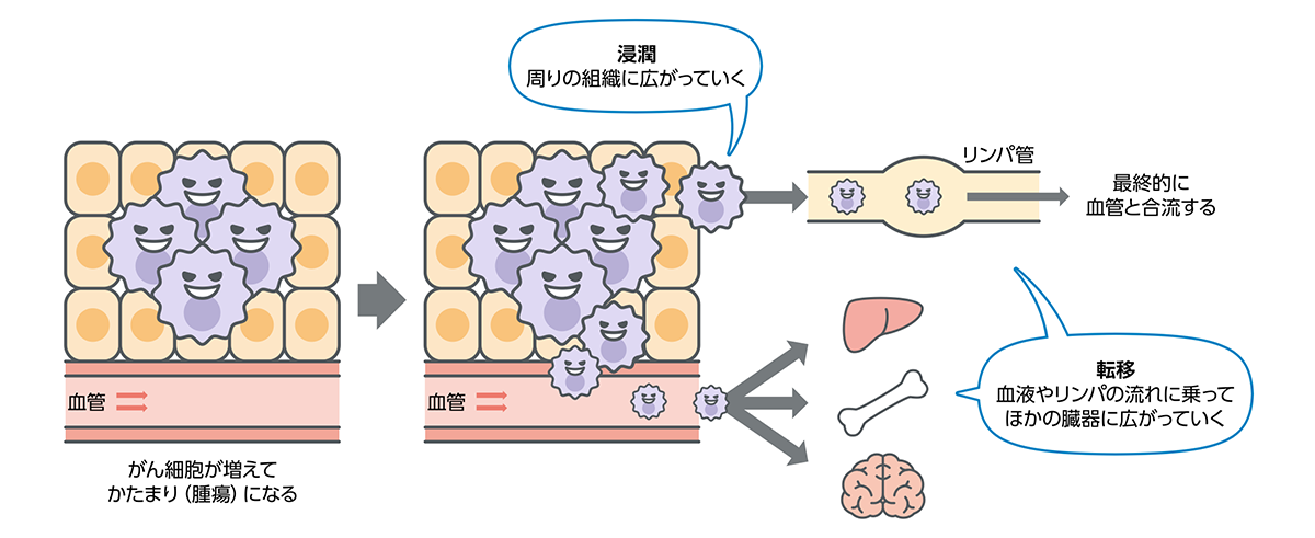 悪性腫瘍と良性腫瘍の違い
