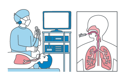 口あるいは鼻に局所麻酔を噴霧した後､ファイバーをゆっくりと挿入