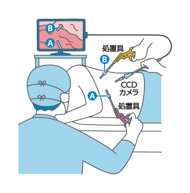 手術も可能な胸腔鏡