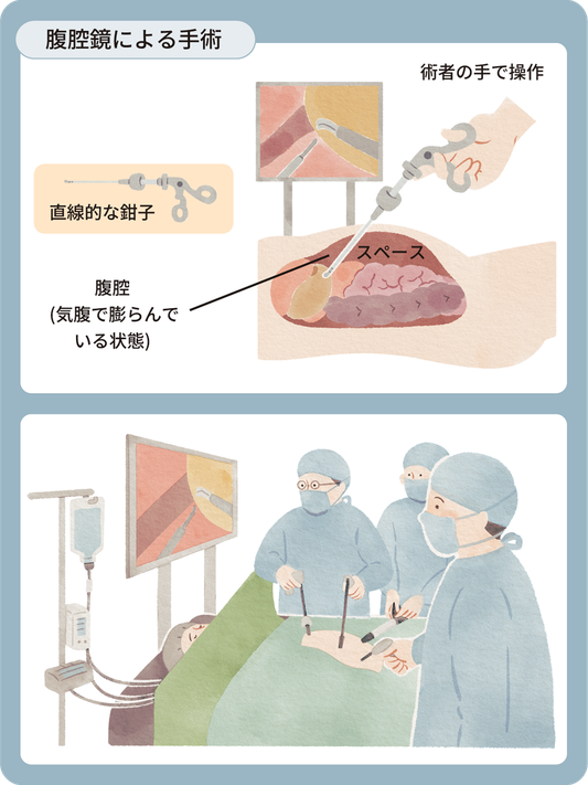 図 腹腔鏡下胃切除術