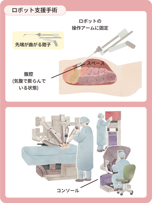図 ロボット支援胃切除