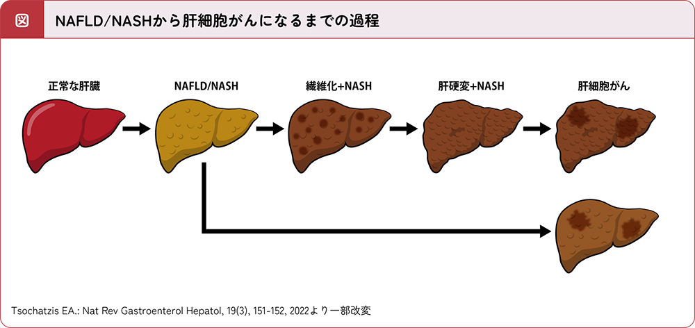 NAFLD/NASHから肝細胞がんになるまでの過程