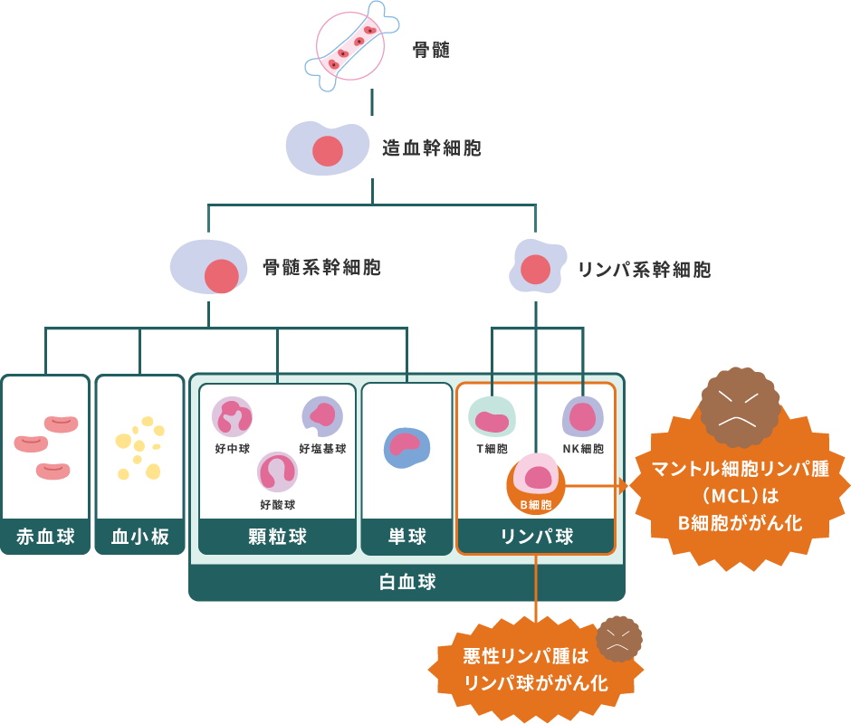 マントル細胞リンパ腫（MCL）はB細胞ががん化、悪性リンパ腫はリンパ球ががん化