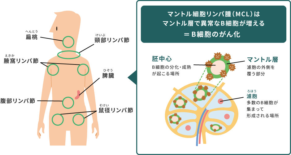 マントル層で異常なB細胞が増える＝B細胞のがん化　胚中心：B細胞の分化・成熟が起こる場所　マントル層：濾胞の外側を覆う部分　濾胞：多数のB細胞が集まって形成される場所