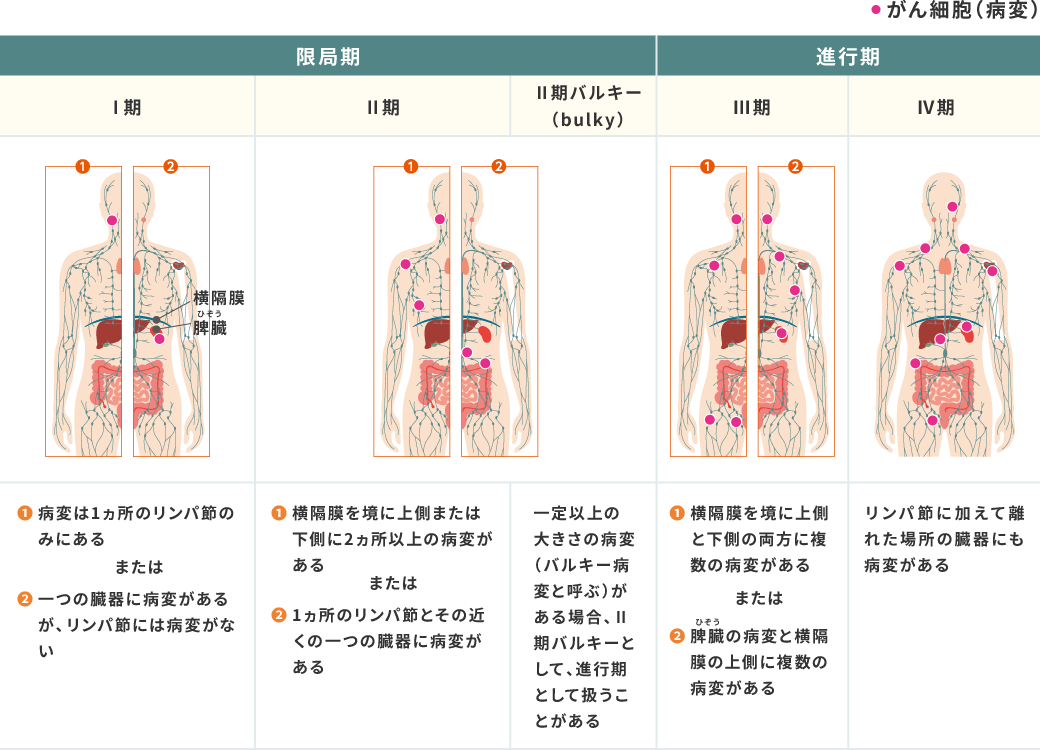 限局期Ⅰ期：病変は1カ所のみリンパ節のみにある または 1つの臓器に病変があるが、リンパ節には病変がない　限局期Ⅱ期：横隔膜を境に上側または下側に2カ所以上の病変がある または 1カ所のリンパ節とその近くの1つの臓器に病変がある　限局期Ⅱ期バルキー（bulky）：通常より大きい病変（バルキー病変と呼ぶ）がある場合、Ⅱ期バルキーとして、進行期として扱うことがある　進行期Ⅲ期：横隔膜を境に上側と下側の両方に複数の病変がある または 脾臓の病変と横隔膜の上側に複数の病変がある　進行期Ⅳ期：リンパ節に加えて離れた場所の臓器にも病変がある