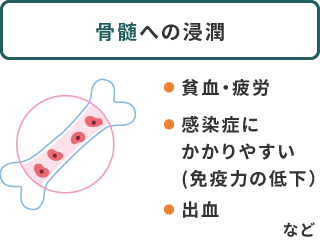 骨髄への浸潤：貧血・疲労、感染症にかかりやすい（免疫力の低下）、出血など