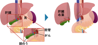 胆管がんに対する肝右葉切除、肝外胆管切除術