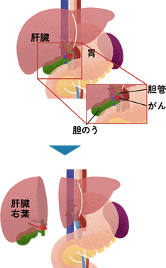 胆管がんに対する肝右葉切除、肝外胆管切除術