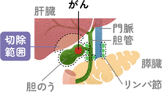 進行期の胆のうがんに対する胆のう切除、肝部分切除、リンパ節切除の例