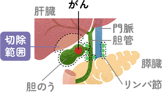 胆道がん（胆管がん・胆のうがん）の治療選択の悩み｜教えて、胆道がん